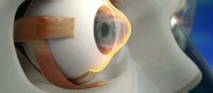 القرنية المخروطية