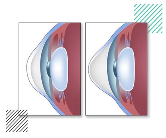keratoconus