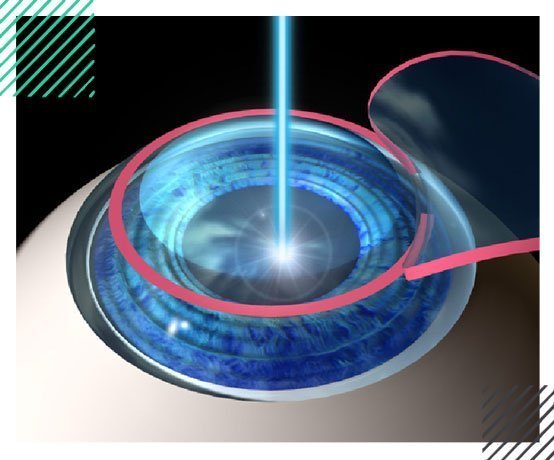 lasik1