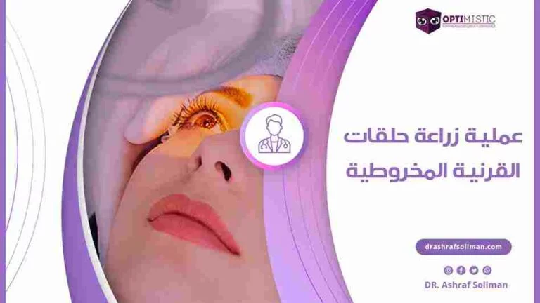 عملية زراعة حلقات القرنية المخروطية في مصر