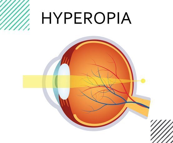 long-sight-hyperopia