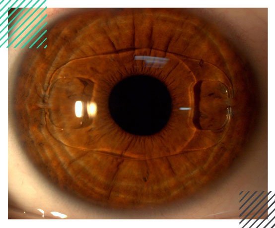 phakic-intraocular-lens