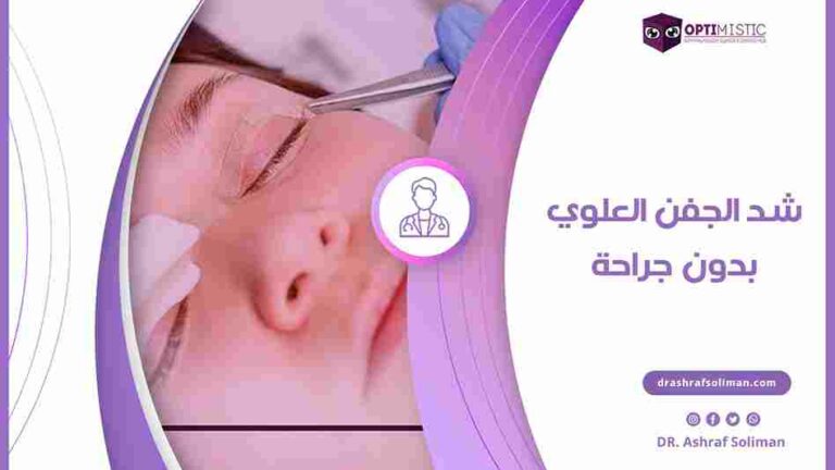 شد الجفن العلوي بدون جراحة