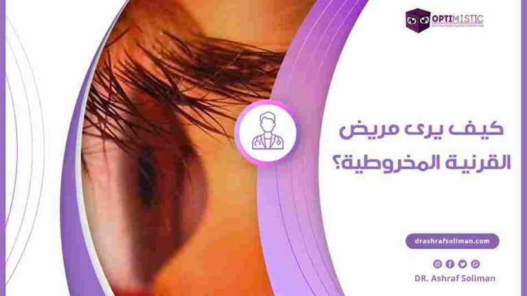 كيف يرى مريض القرنية المخروطية