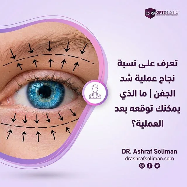 نسبة نجاح عملية شد الجفن 2026