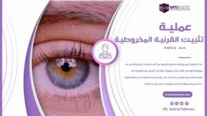 تكلفة عملية تثبيت القرنية المخروطية