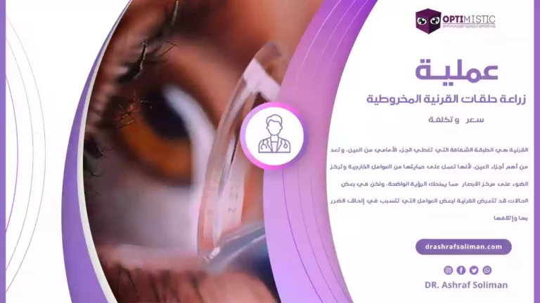 تكلفة عملية زراعة حلقات القرنية المخروطية في مصر