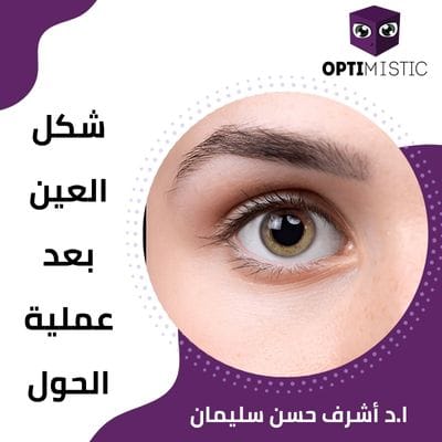شكل العين بعد عملية الحول