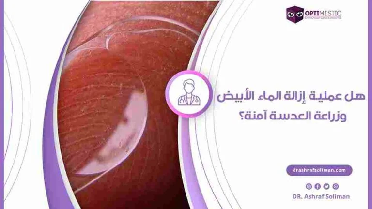 هل عملية إزالة الماء الأبيض وزراعة العدسة آمنة؟