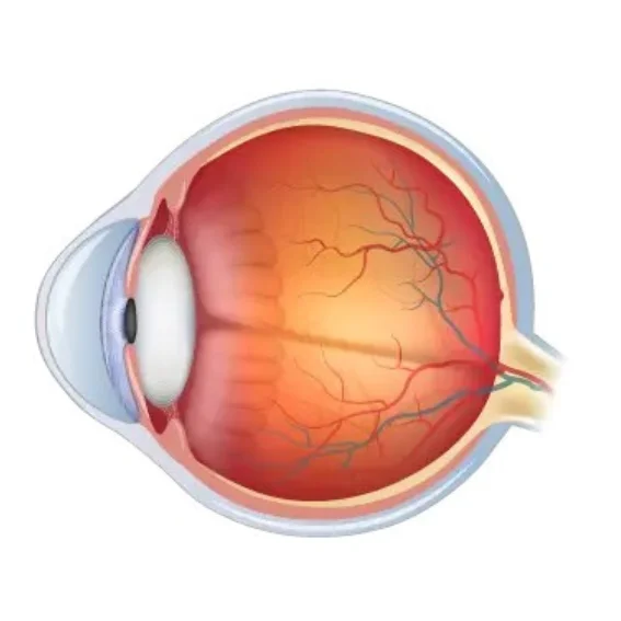 علاج القرنية المخروطية