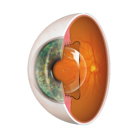 عملية زراعة العدسات