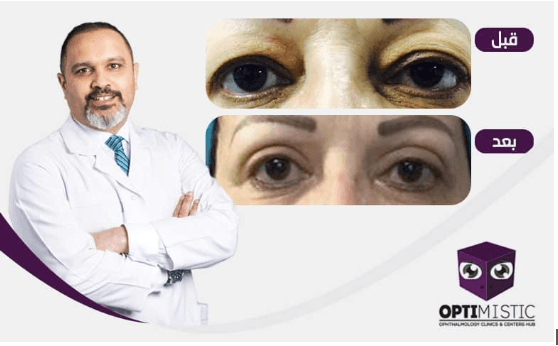 Blepharoplasty surgery in egypt