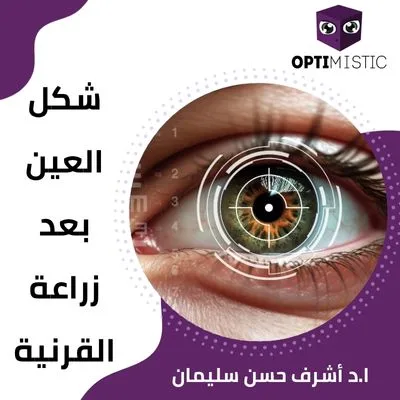 شكل العين بعد زراعة القرنية