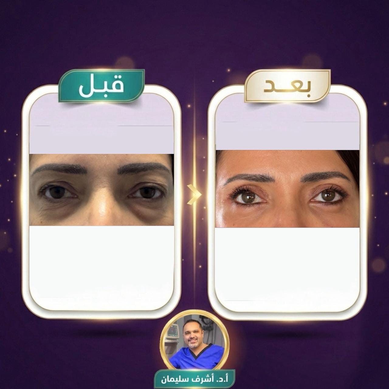 نتيجة عملية شد الجفون - الحالة الأولى - قبل وبعد - د. أشرف سليمان