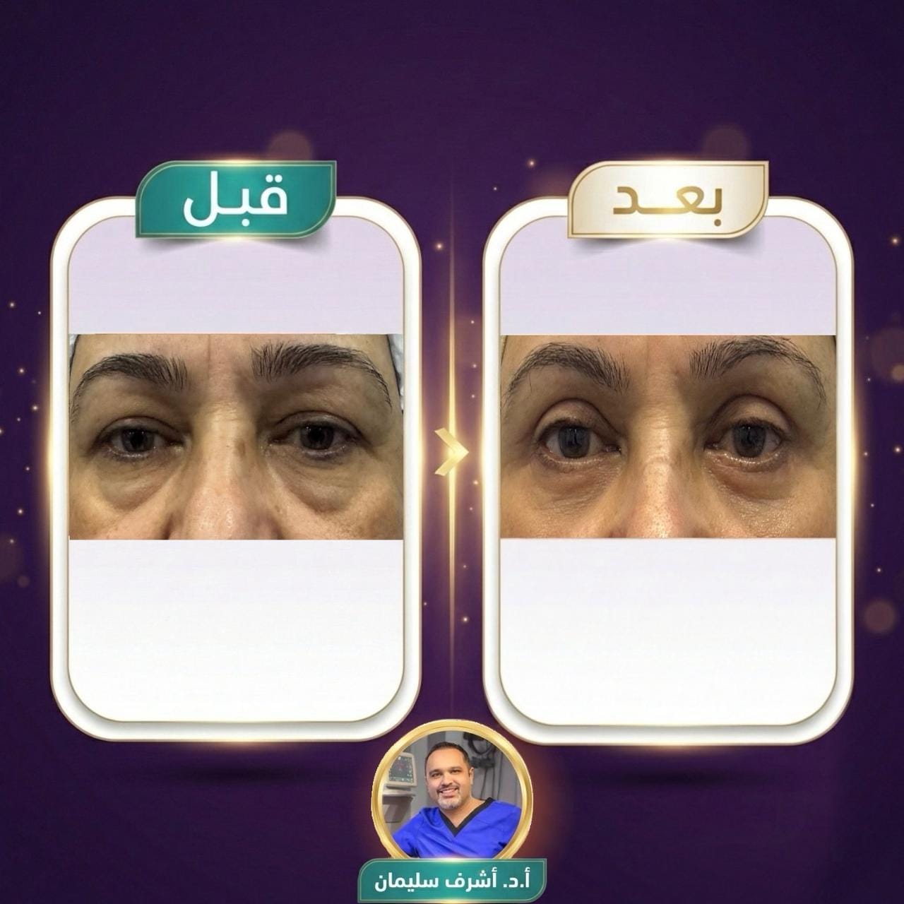 نتيجة عملية شد الجفون - الحالة الثانية - قبل وبعد - د. أشرف سليمان