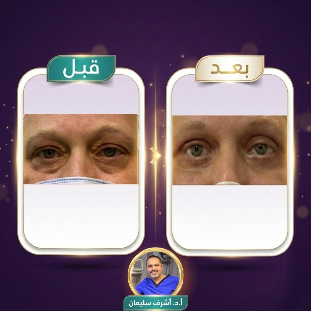 نتيجة عملية شد الجفون - الحالة الثانية - قبل وبعد - د. أشرف سليمان