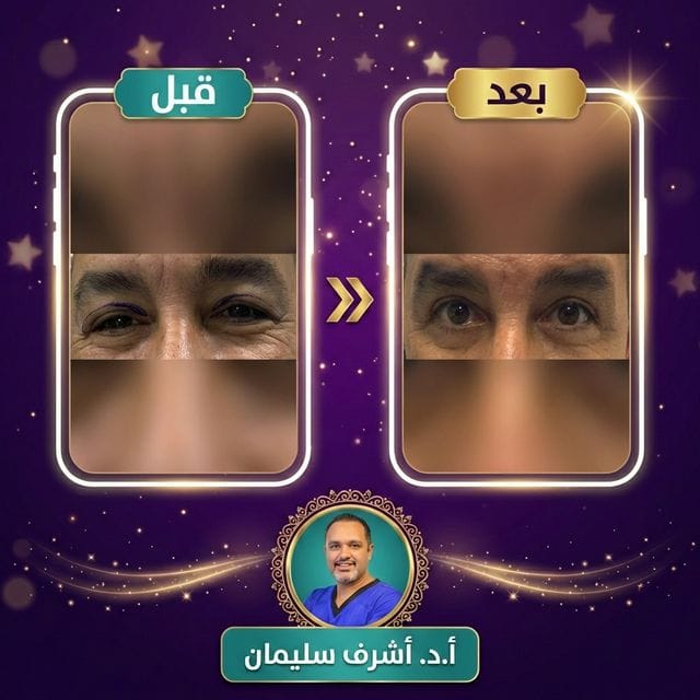 نتيجة منى - قبل وبعد