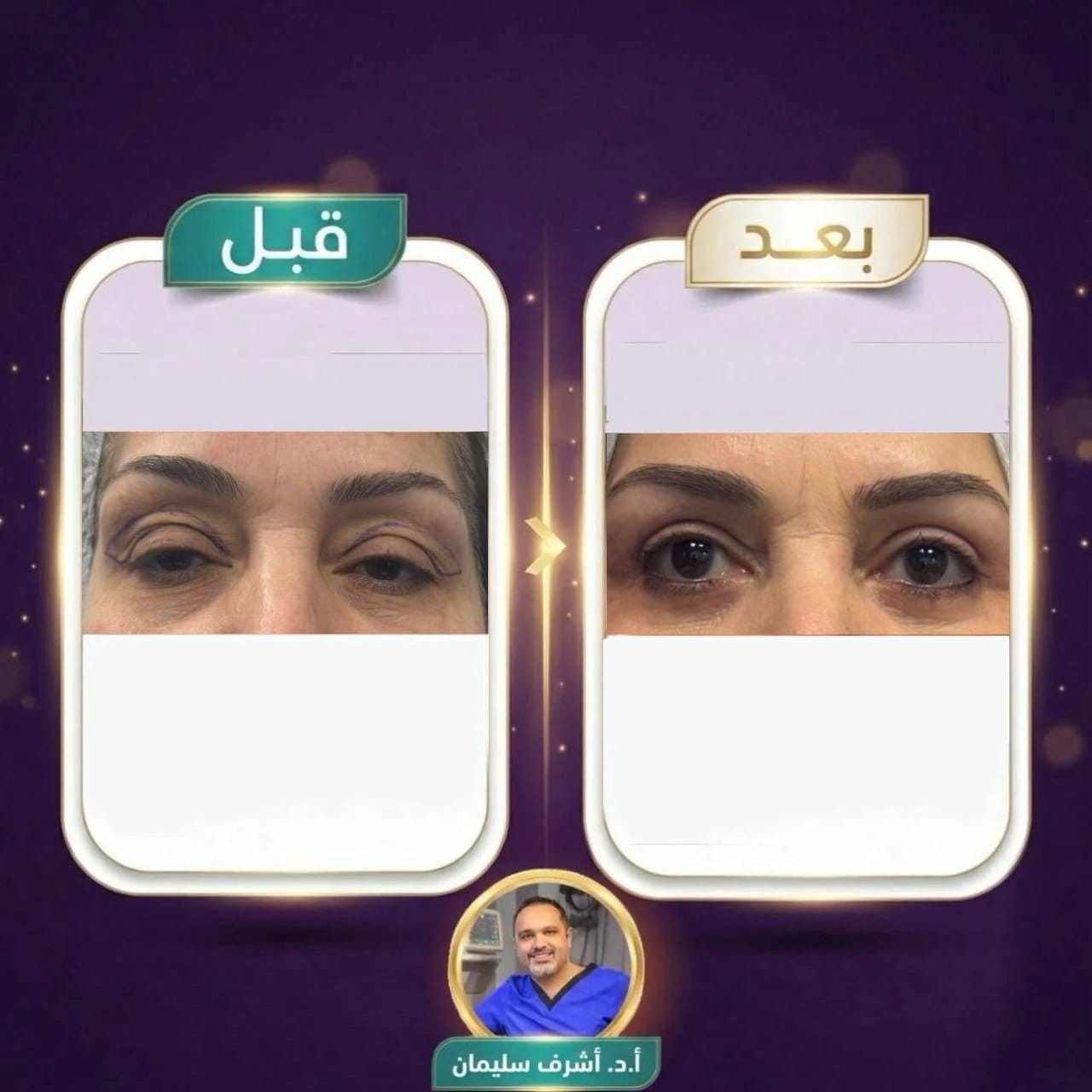 نتيجة عملية شد الجفون - قبل وبعد